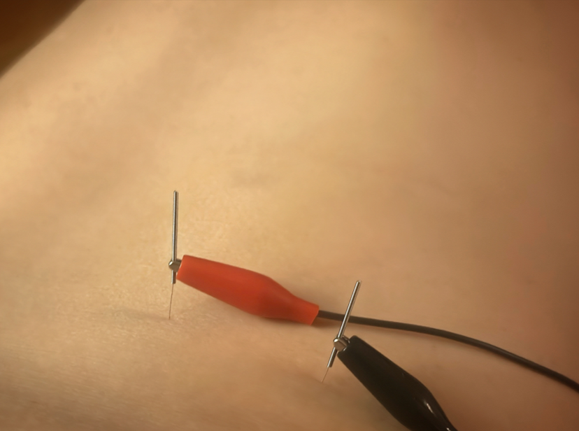 electroacupunture in acupuncture clinic at montvale, new jersey 07645.png