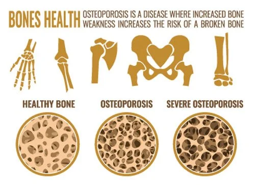 Bone Health in Perimenopause and Menopause