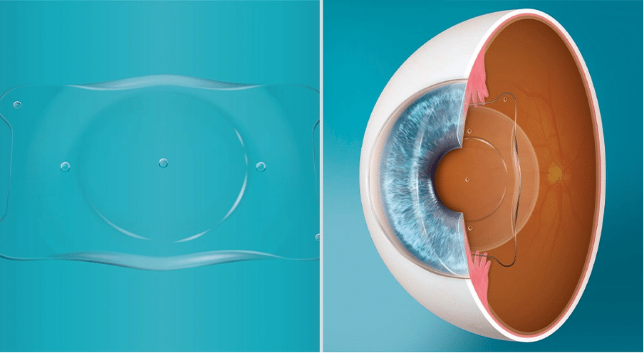 Close-up macro photo of a natural eye illustrating EVO ICL implantation for nearsightedness in Miami.