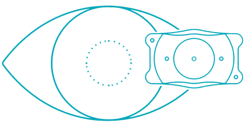 Side-view macro eye image representing EVO ICL vision correction in Miami