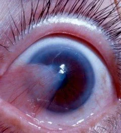 pterygium.jpg