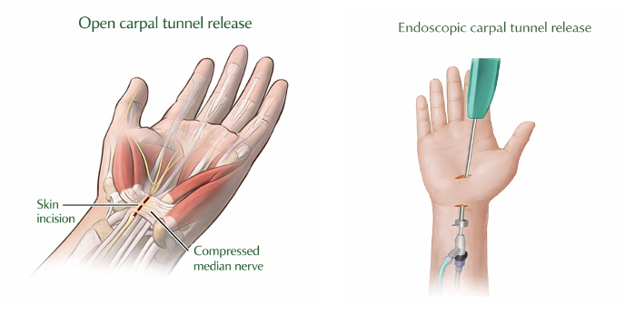 What is the difference between open and endoscopic carpal tunnel release?