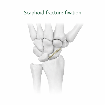 What are scaphoid fractures?