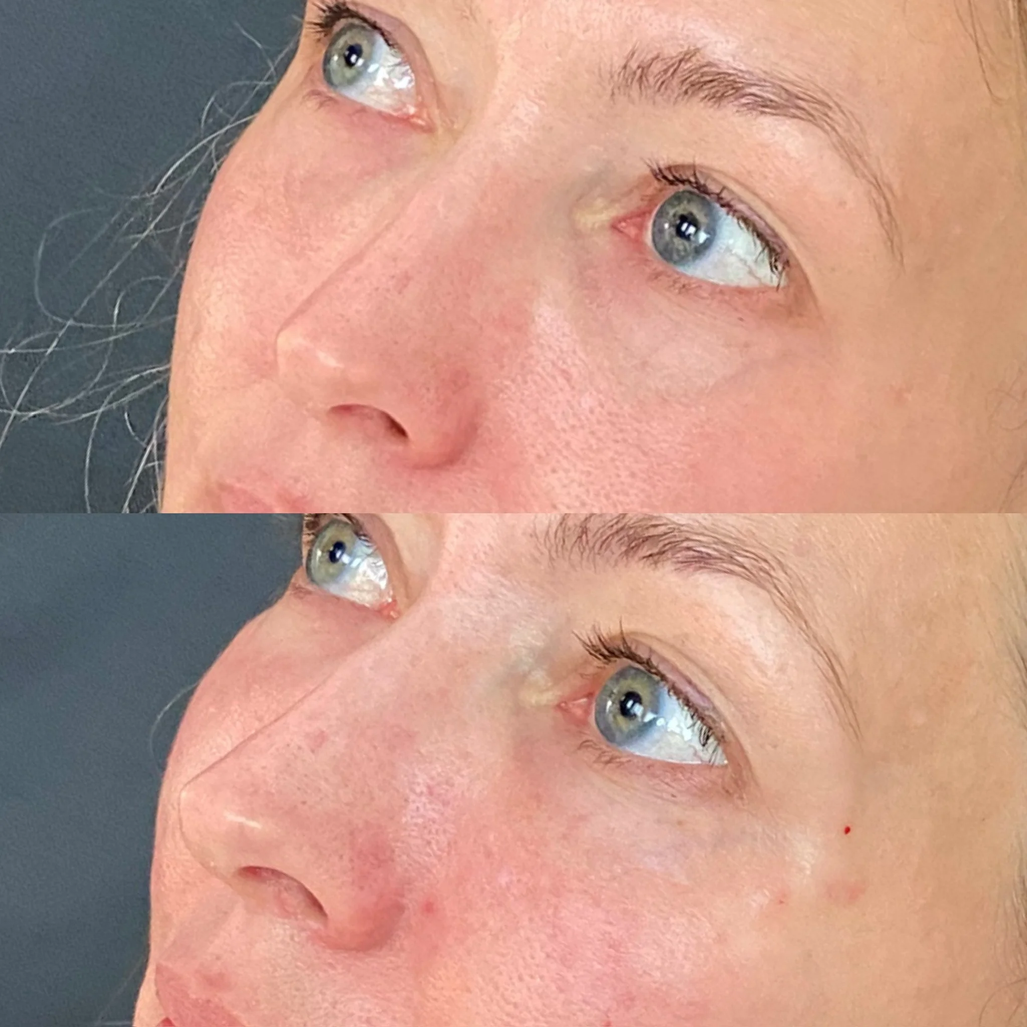 02-PRF liquid under eye injections.JPG