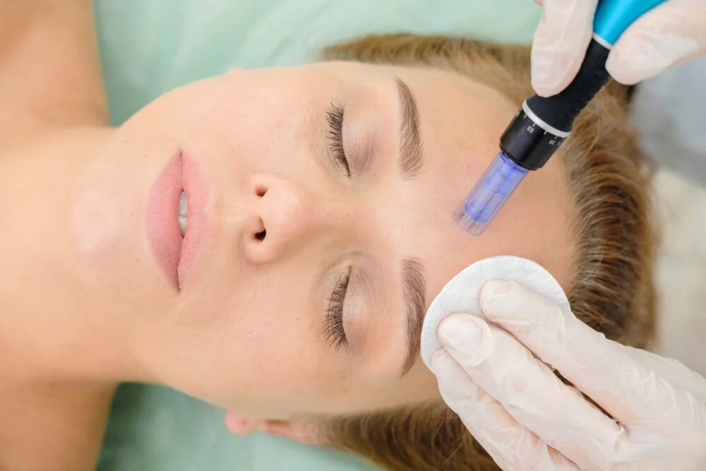 Microneedling Info Session
