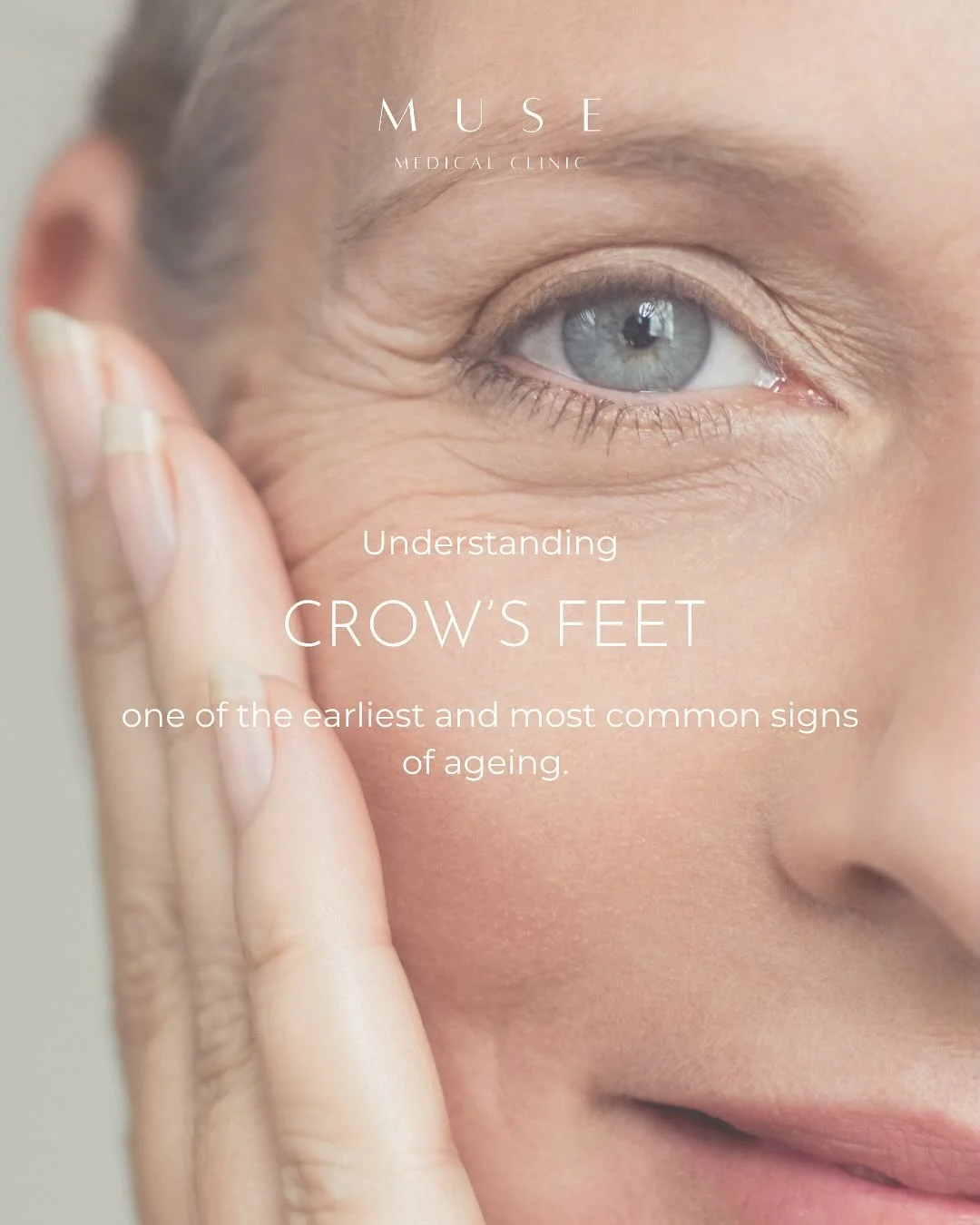 Understanding Crow&rsquo;s Feet ✨⁠
⁠
Crow&rsquo;s feet - the fine lines that appear around the corners of the eyes - are one of the earliest and most common signs of ageing. They&rsquo;re a completely natural part of life, often formed from years of 