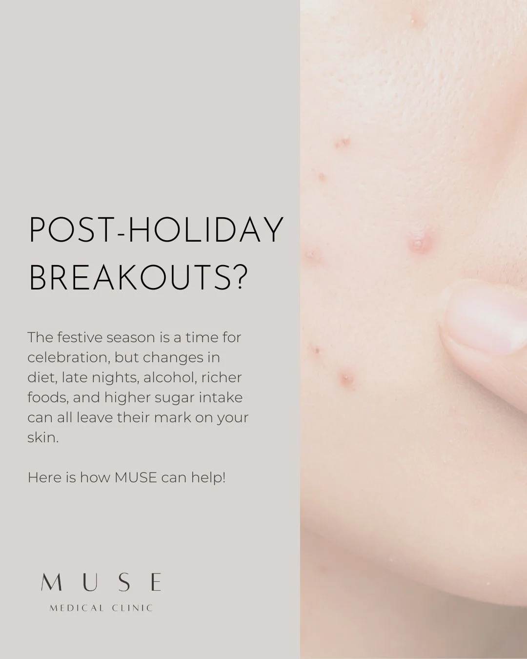 Post-Holiday Breakouts? Here&rsquo;s How We Can Help ✨⁠
⁠
The festive season is a time for celebration, but changes in diet, late nights, alcohol, richer foods, and higher sugar intake can all leave their mark on your skin. If you&rsquo;ve noticed mo