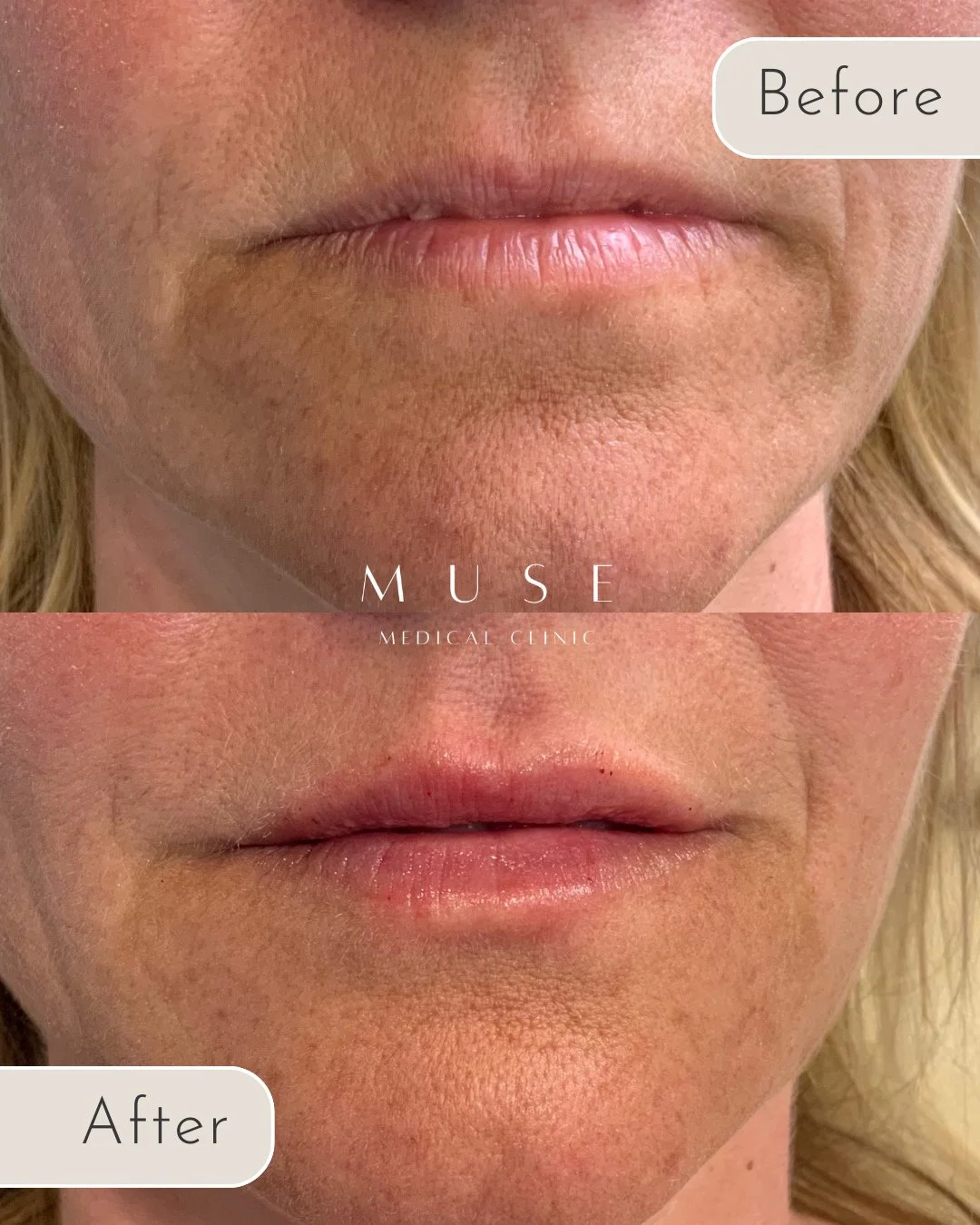 Beautifully Subtle Lip Enhancement at MUSE ✨⁠
⁠
This before &amp; after is the perfect example of our philosophy at MUSE Medical Clinic: refinement, not reinvention.⁠
⁠
Here, the lips began slightly thinner with fine lines and a lack of hydration. ⁠
