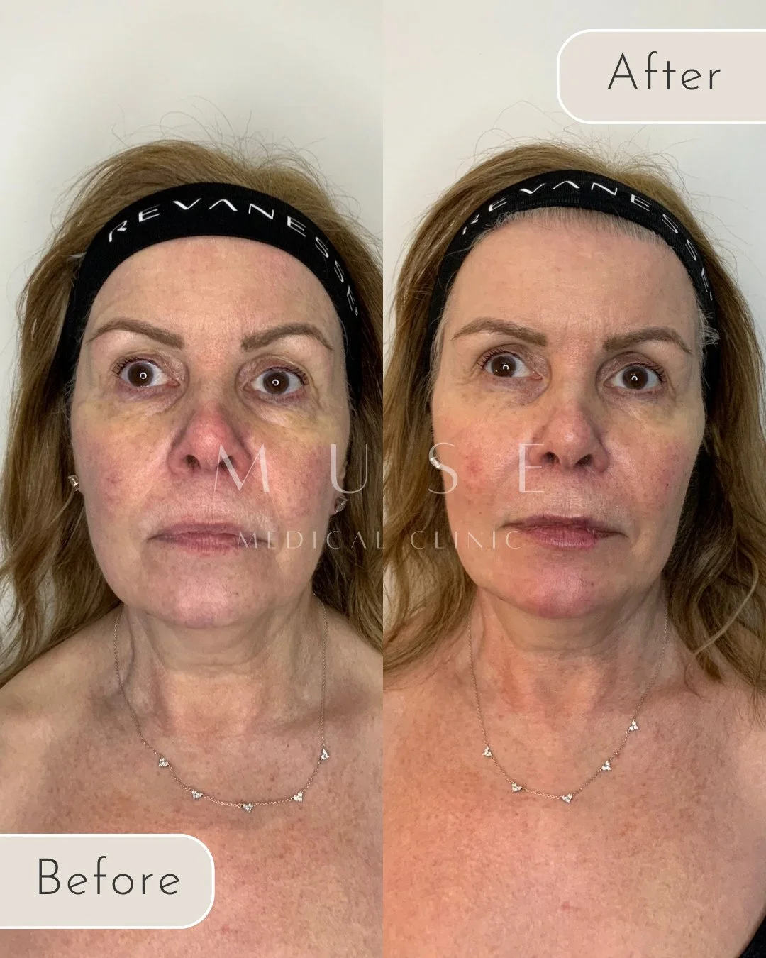 Subtle structure. Thoughtful balance. Refined results.⁠
⁠
This Revanesse&reg; dermal filler transformation, performed by Dr Amy Watson, focuses on restoring facial balance while preserving what makes the face uniquely theirs.⁠
⁠
Using precise placeme