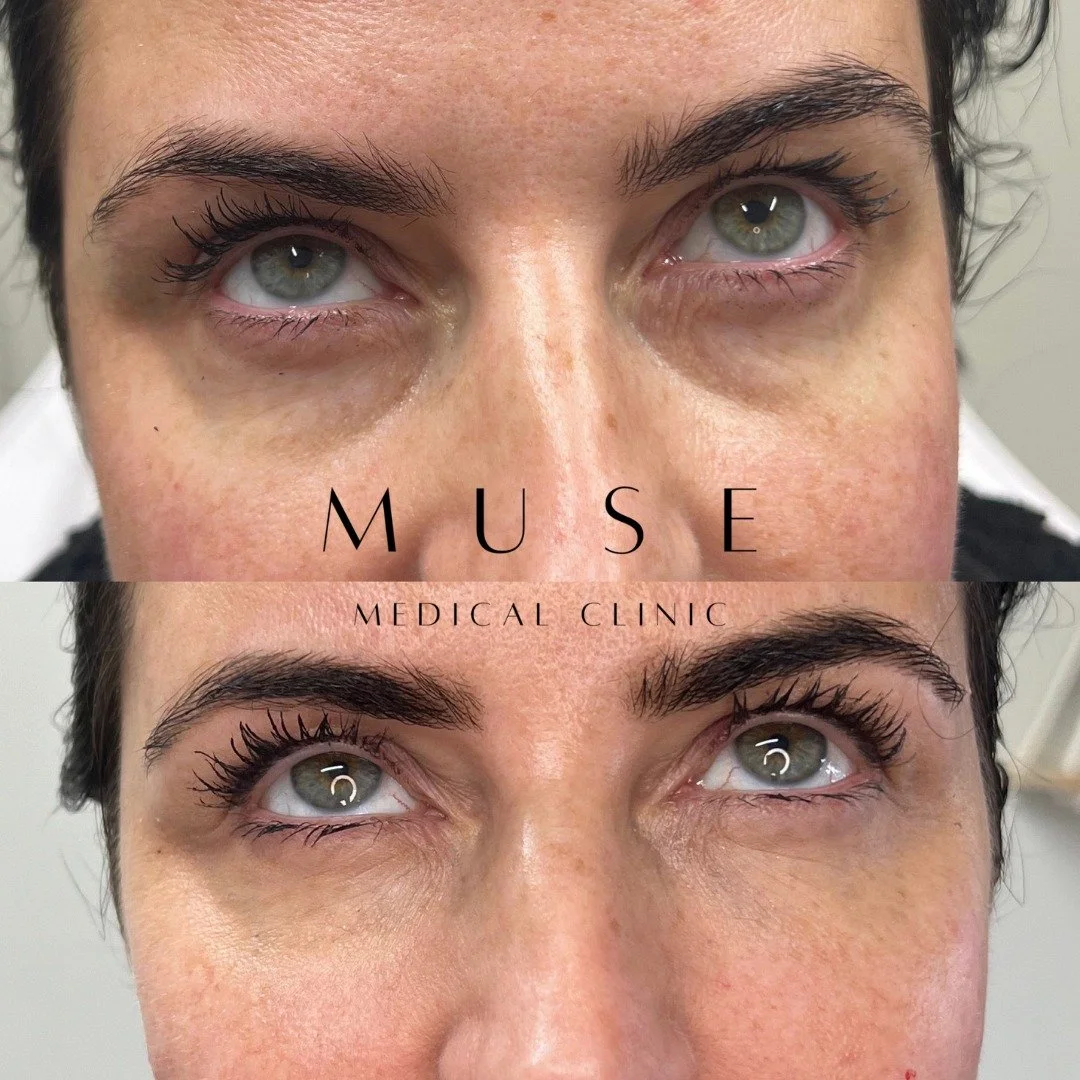 Looking tired when you're not is one of the most common things patients come to us about. And it's also one of the most treatable 💫

The under-eye area is something we feel really passionate about getting right. It's the first thing people notice wh