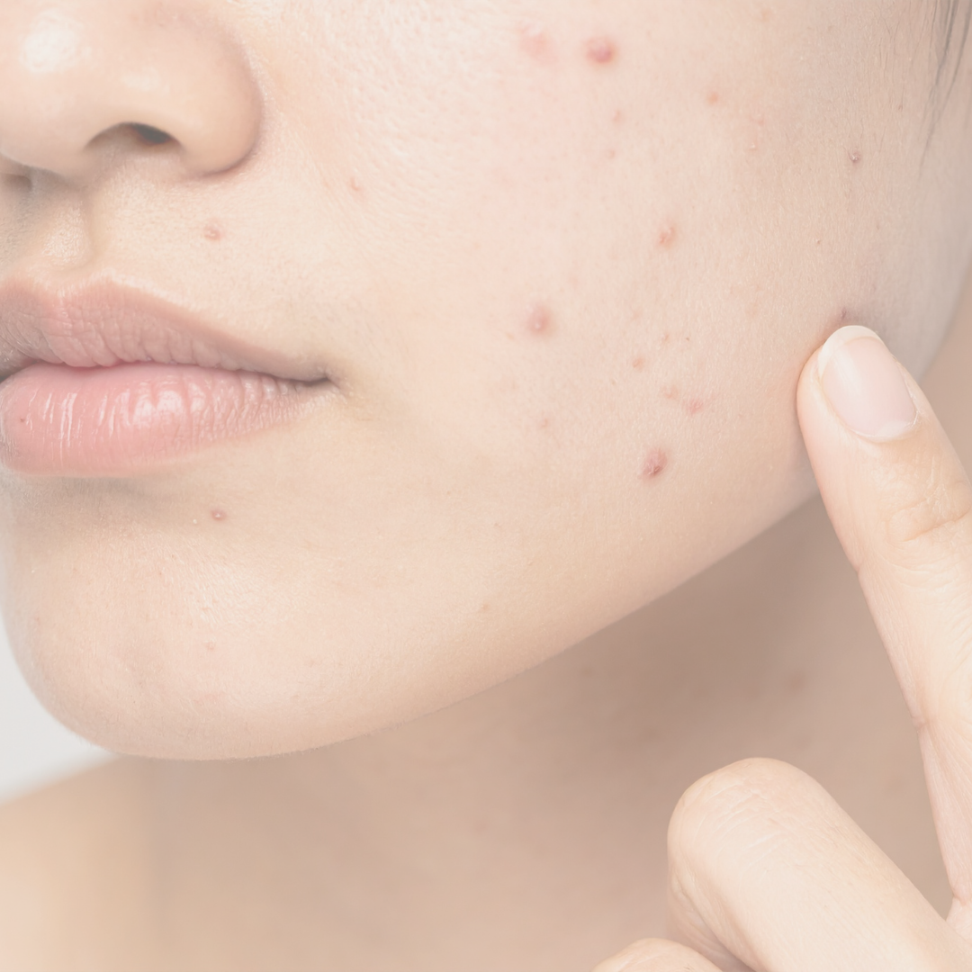 A close-up of a person's face showing acne and pimples on the cheek, with a finger pointing to the skin.