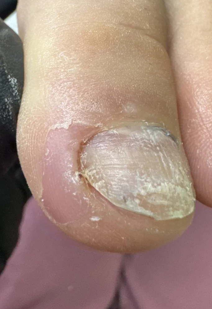 Close-up of a person's thumbnail with damaged, peeling skin and some buildup, possibly caused by a nail fungus or skin condition.