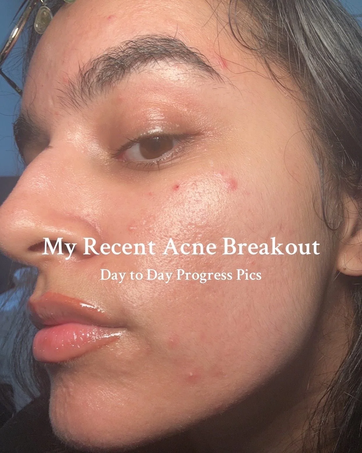 My recent acne breakout in pictures:
 
Last week I broke out again for the first time in over a year. It felt like i took one step forward to only take a million back. But I remembered all of the things I learnt throughout my struggle with acne. The 