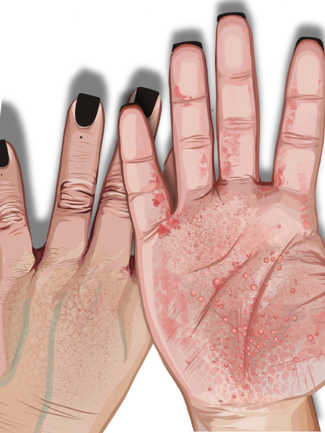 Dyshidrotic Dermatitis