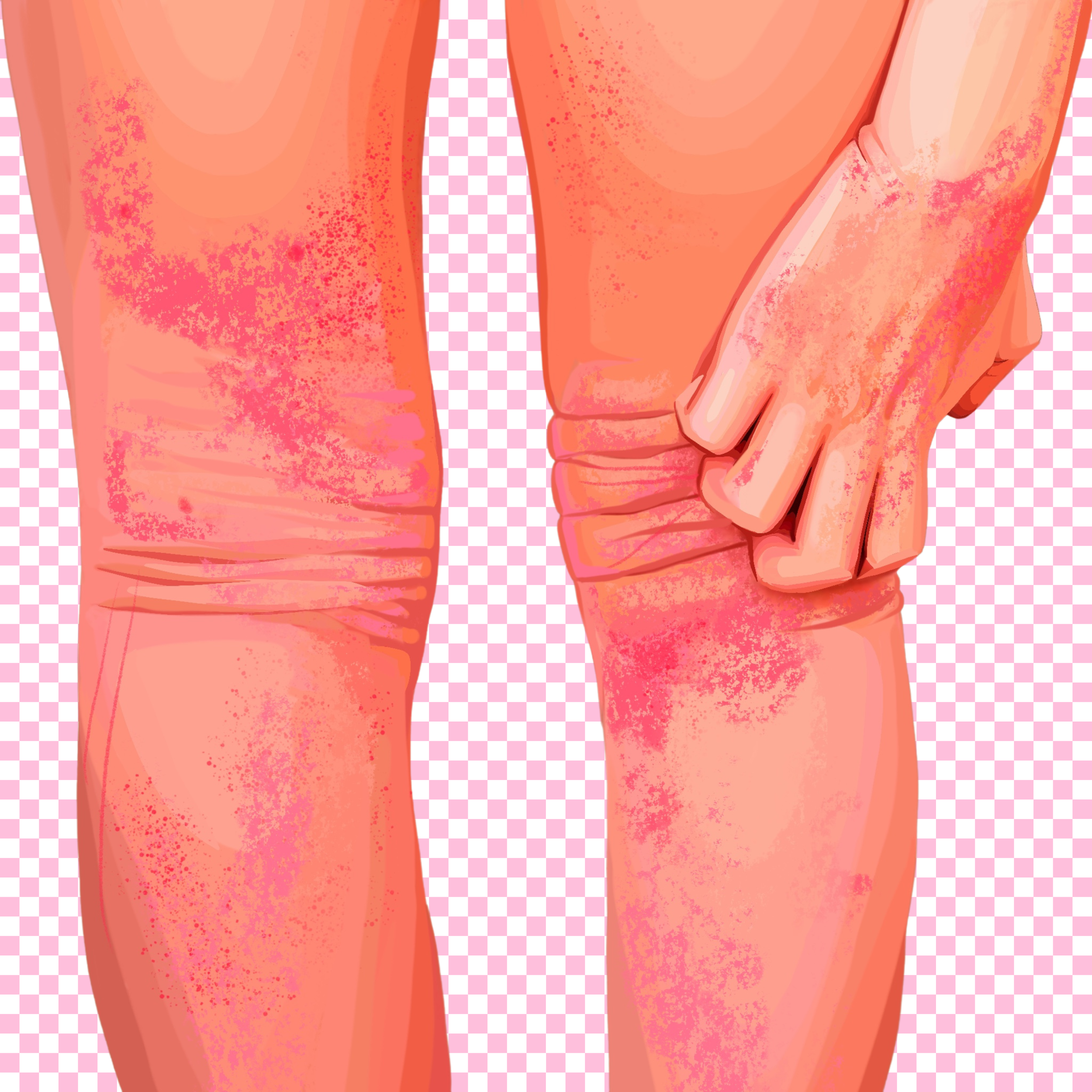 A digital illustration depicting a person holding their knee with visible redness and irritation on the skin.