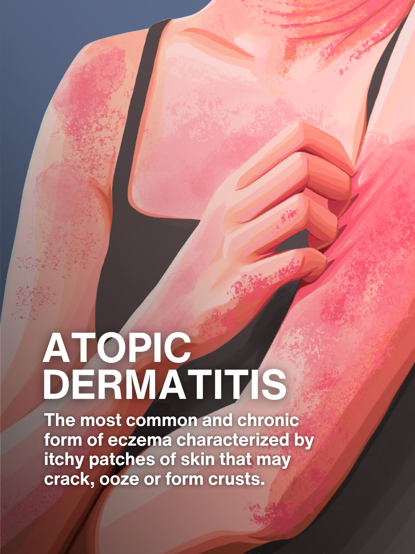 Atopic Dermatitis