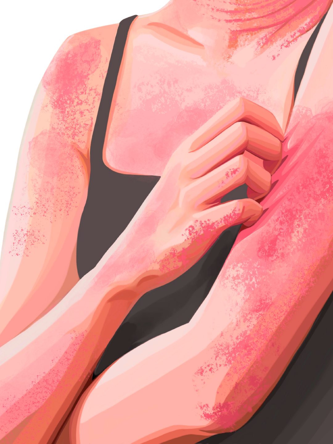 Atopic Dermatitis