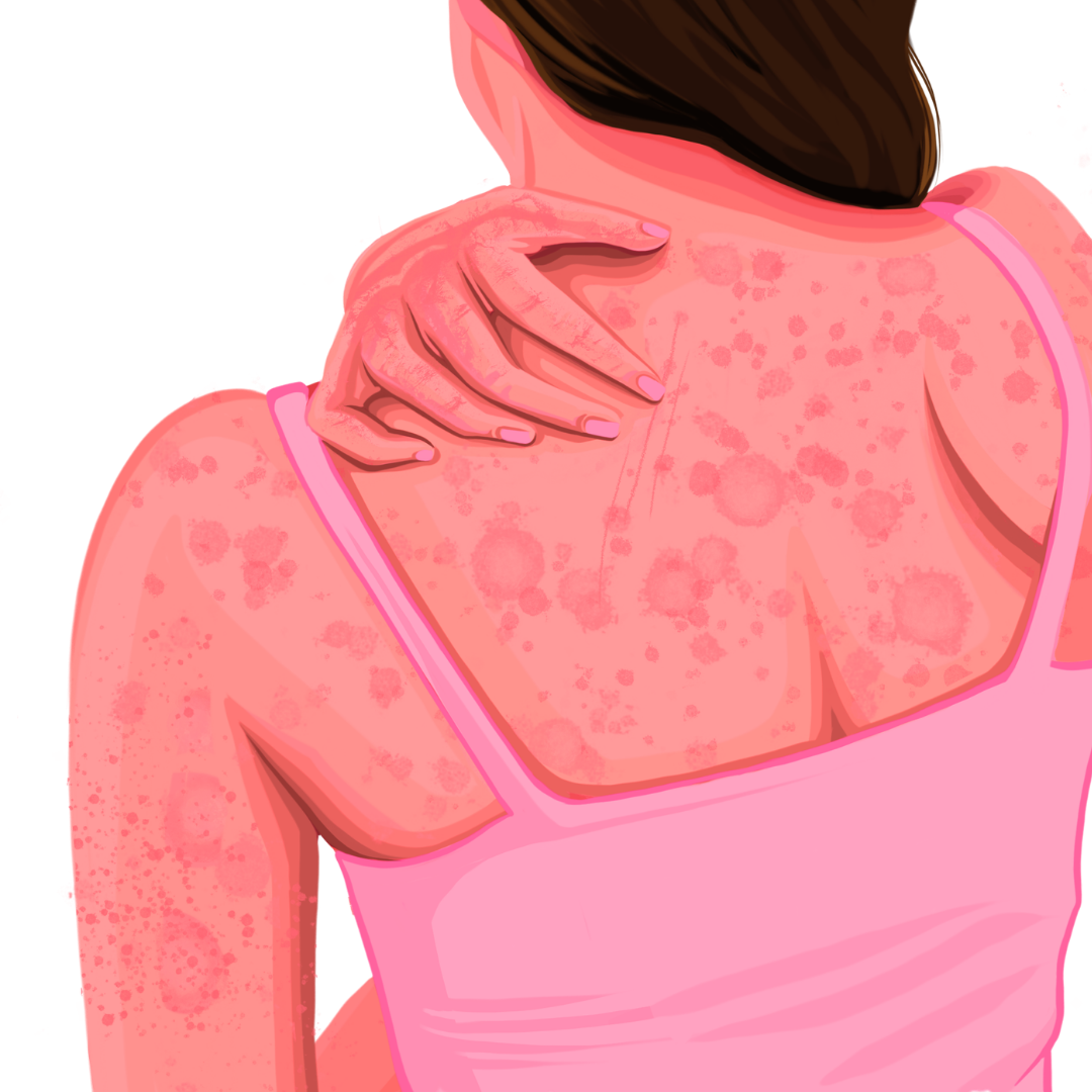 Discoid/ Nummular Dermatitis