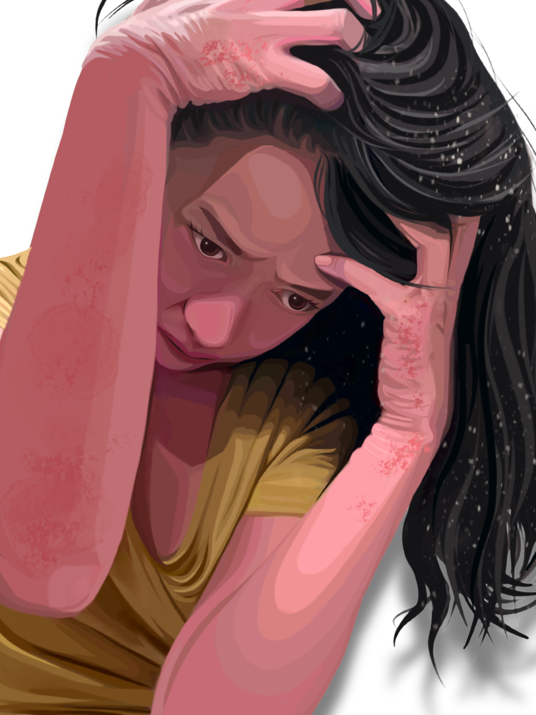 Seborrheic Dermatitis