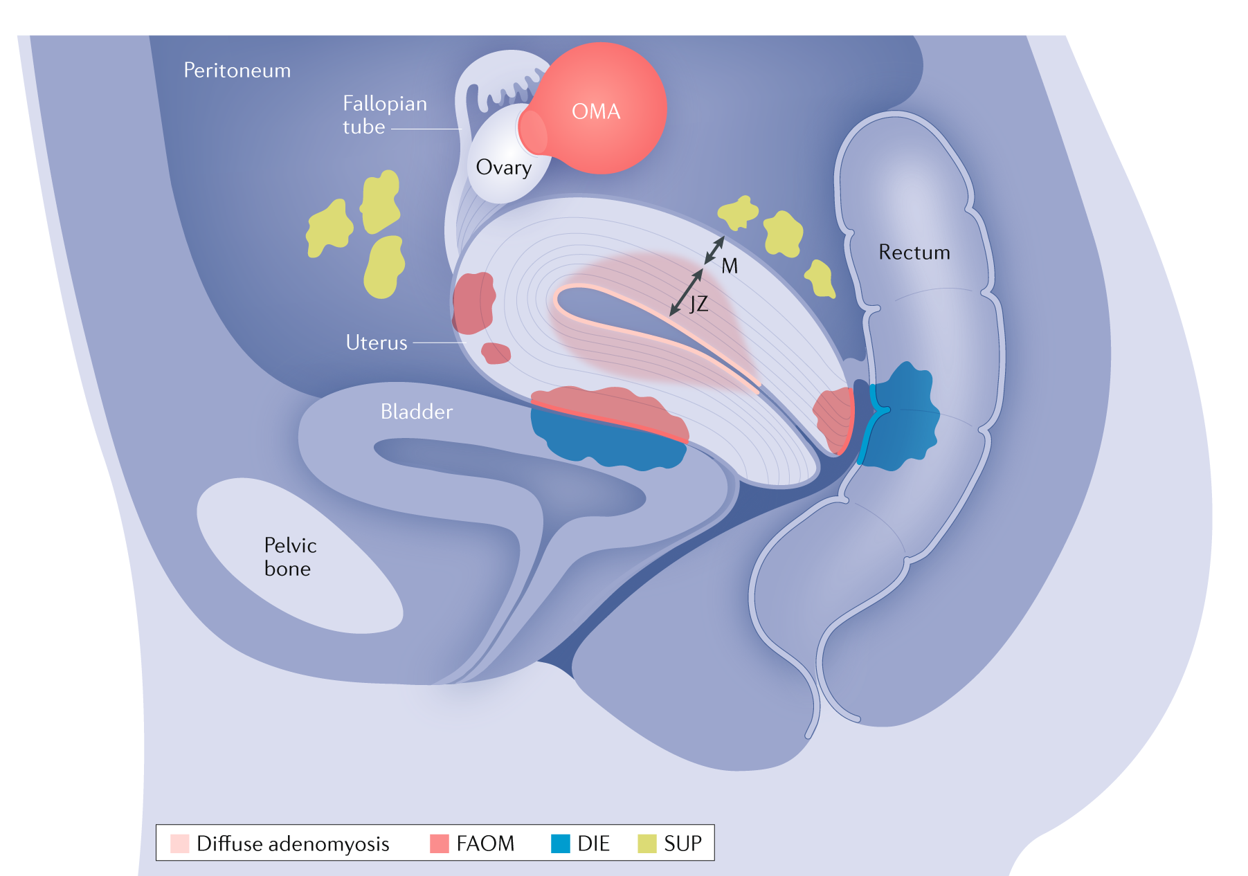 An illustration of the female pelvic anatomy showing a cross-section of the reproductive organs, bladder, rectum, and pelvic bones, with marked areas of diffuse adenomyosis, fibroadenomyosis, deep infiltrating endometriosis, and superficial endometriosis.