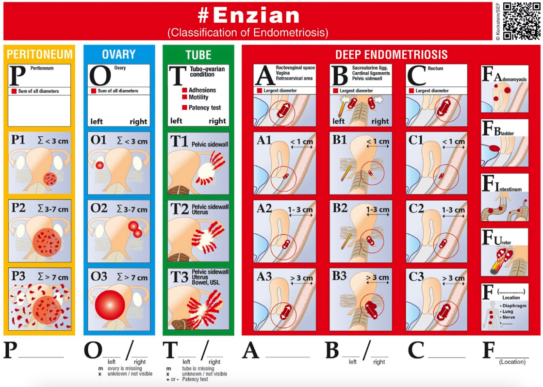 A chart displaying the classification of endometriosis, with sections for peritoneum, ovary, tubo-ovarian condition, deep endometriosis, and endometriosis location, using symbols and measurements to illustrate different levels and types of endometriosis.