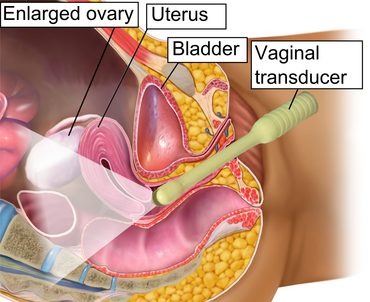 Diagram of female reproductive organs showing the enlarged ovary, uterus, bladder, and vagina with a vaginal transducer inserted into the vaginal canal.