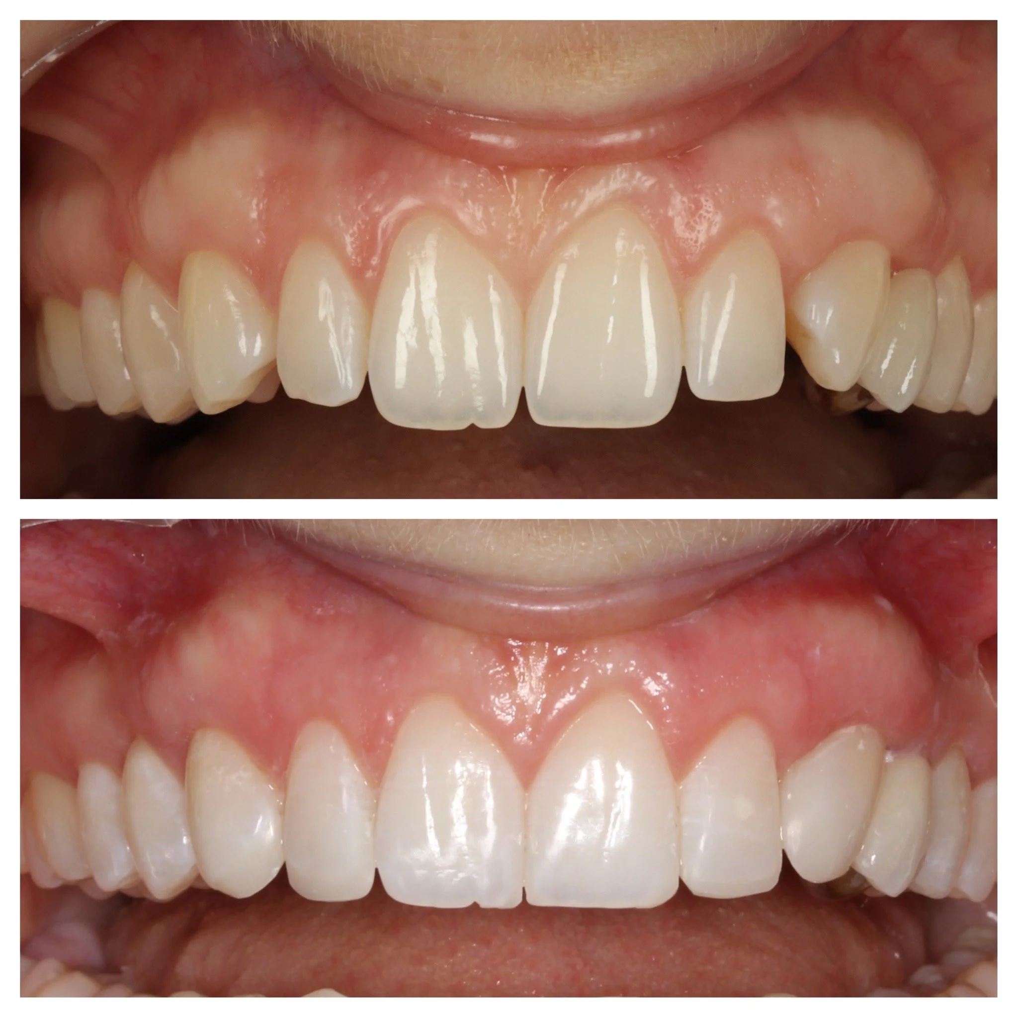 Before and after cosmetic dentistry showing upper front teeth with whitening and improved alignment by a cosmetic dentist in Londonnce.