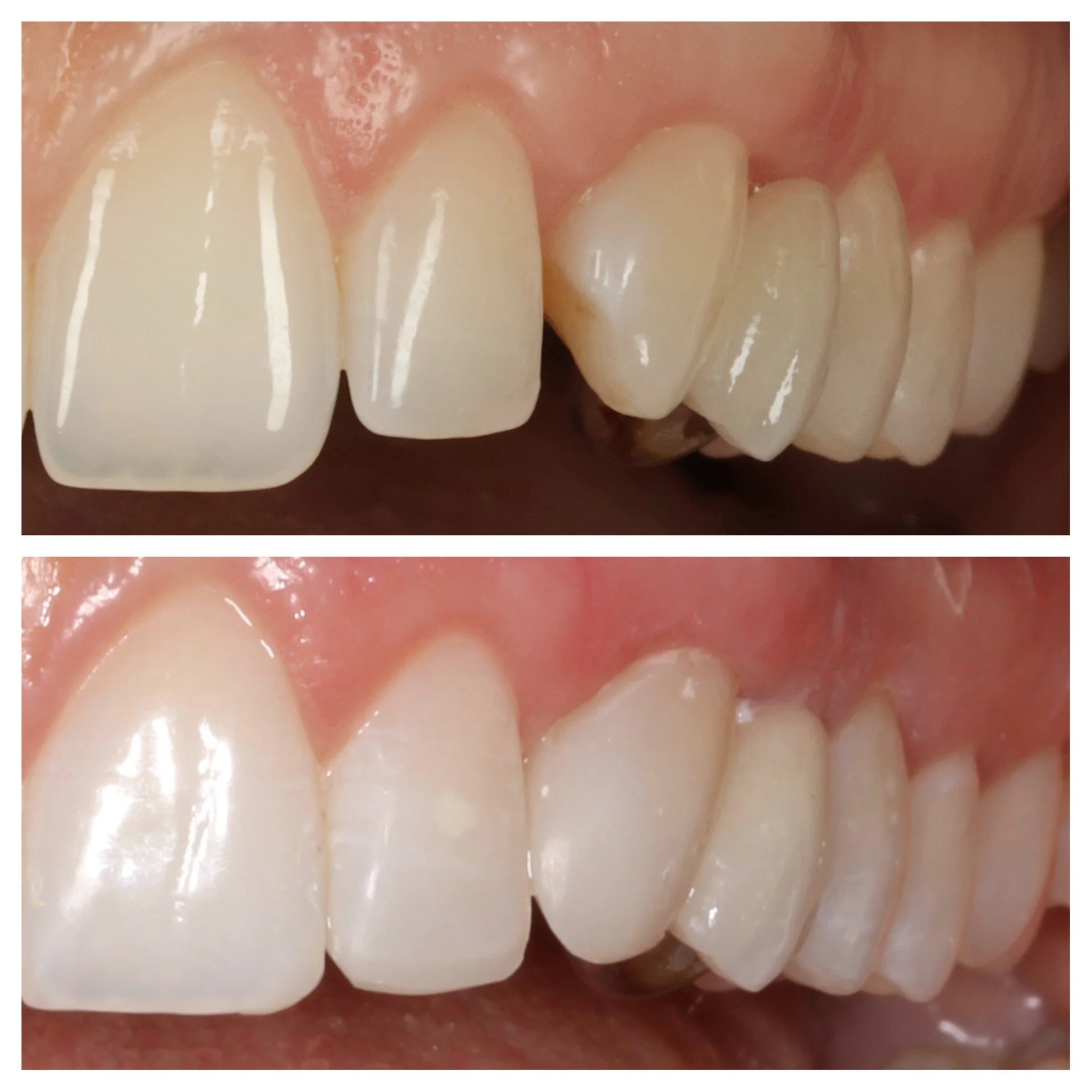 Close-up of teeth on a patients left side showing Before and after cosmetic dentistry showing upper front teeth with whitening and improved alignment by a cosmetic dentist in London