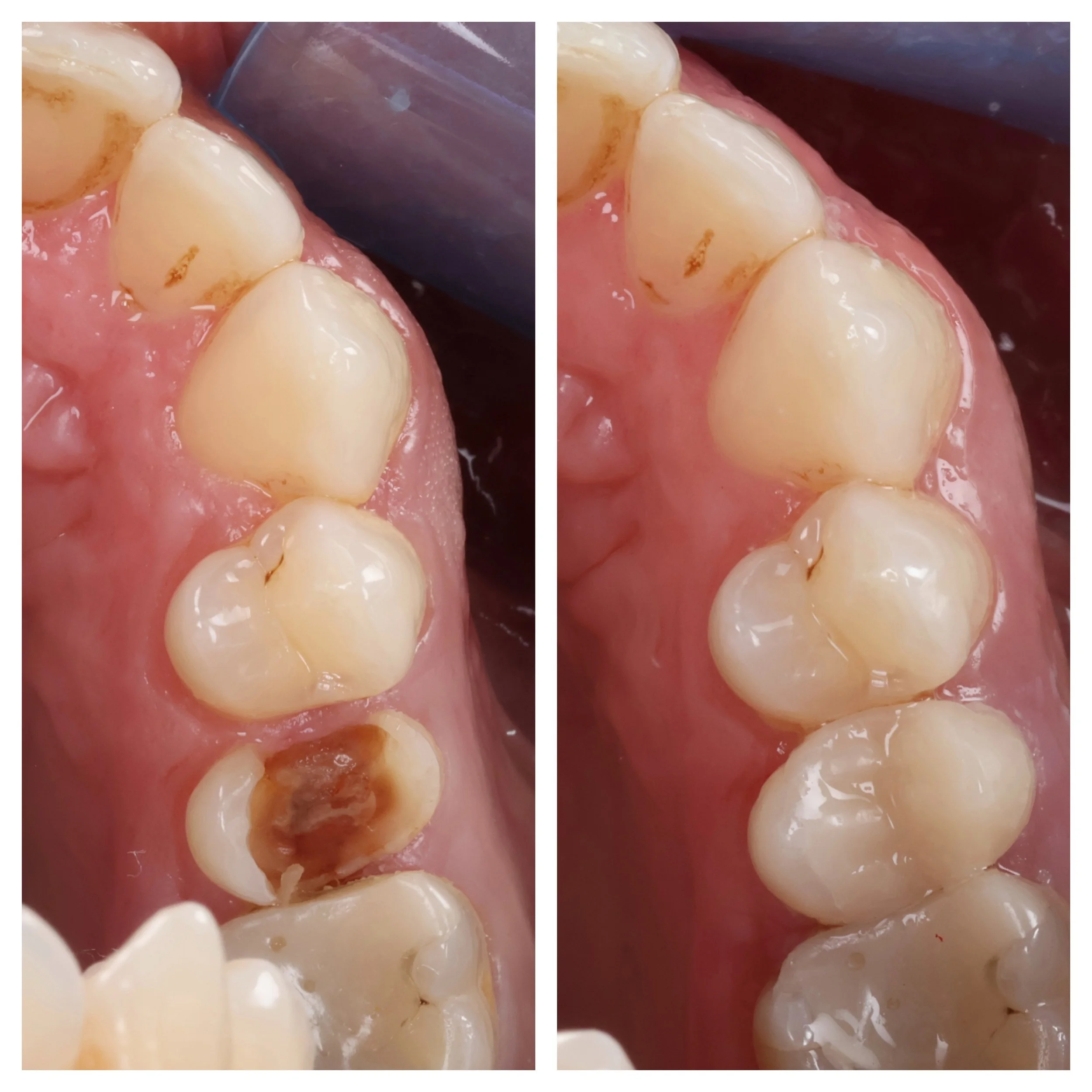 Before and after photo showing a decayed tooth restored with a direct composite build up