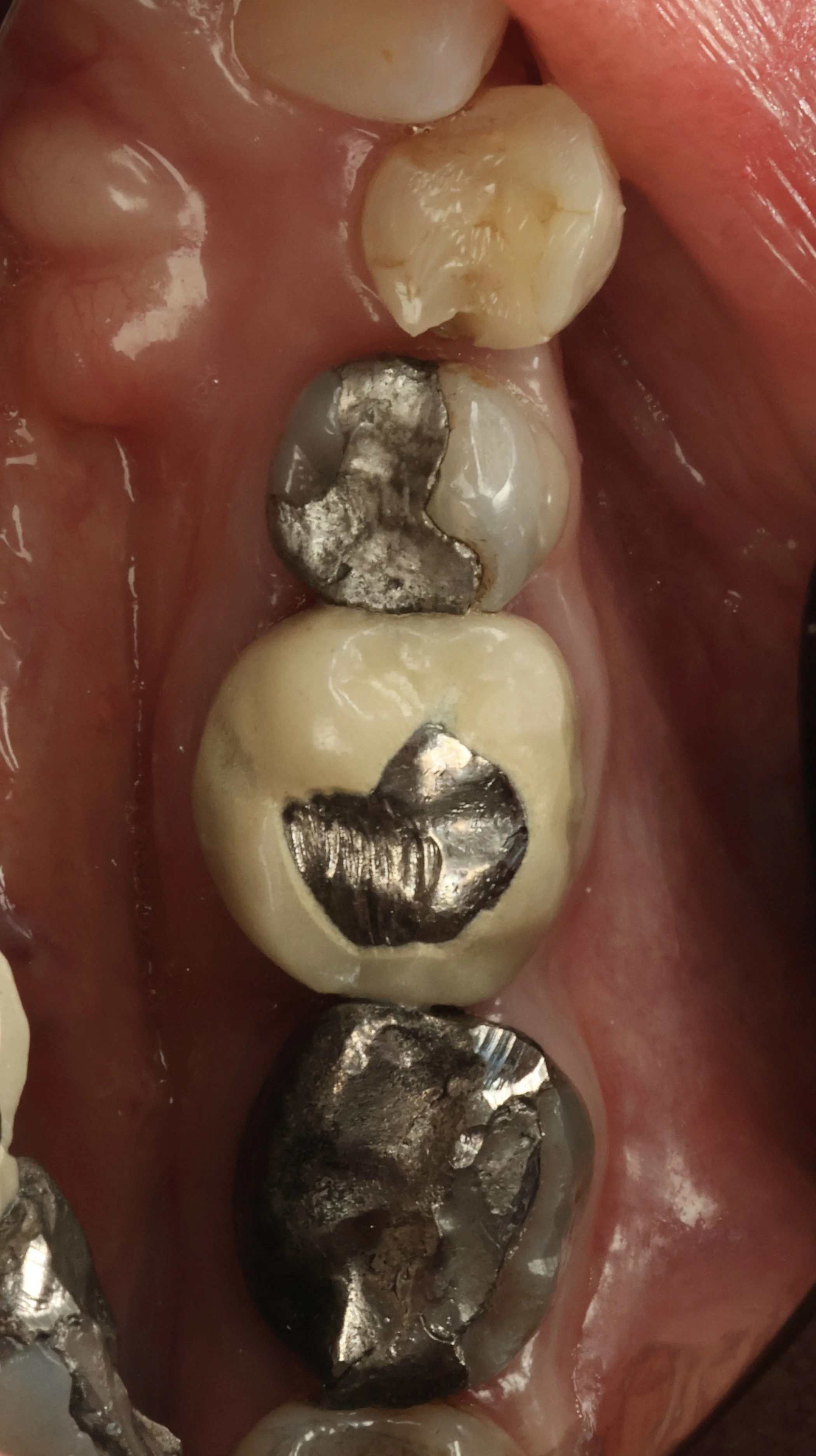 Close-up of human molar teeth, some with metal dental fillings, showing decay and damage.
