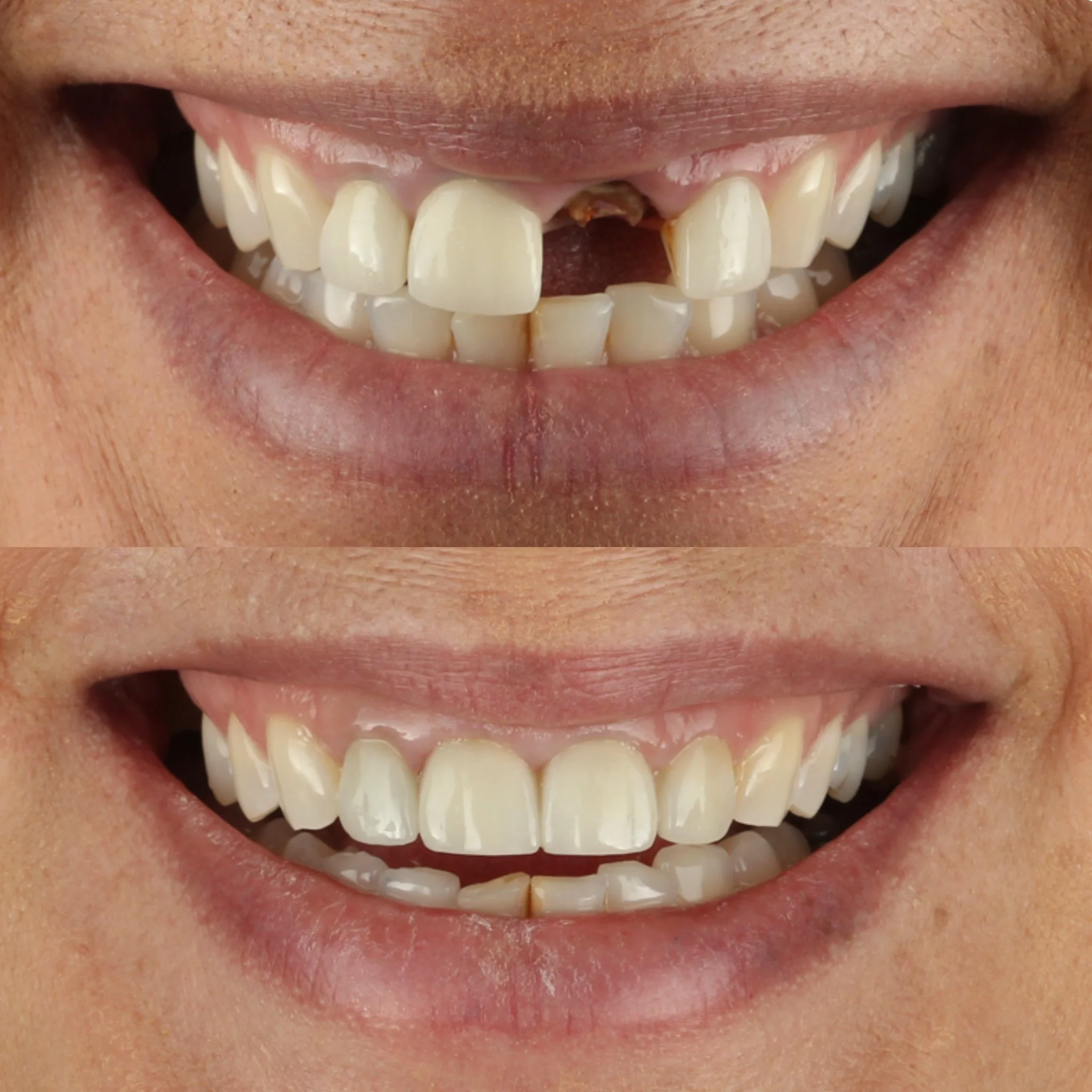 Before and after dental restoration image showing significant improvement in tooth appearance, alignment and oral health through crowns, composite fillings and cosmetic dentistry treatment.
