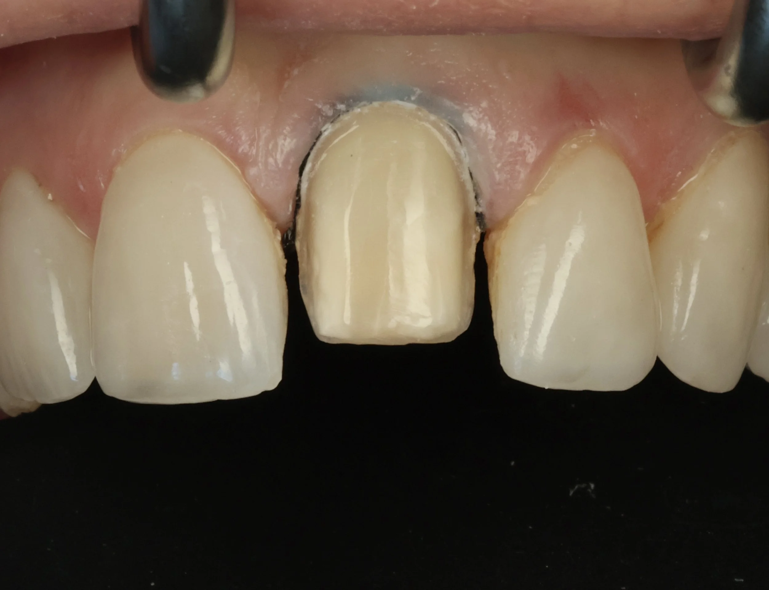 Close up of upper front teeth showing a central incisor which has been prepped prior to having a Dental veneer cemented during cosmetic dental treatment