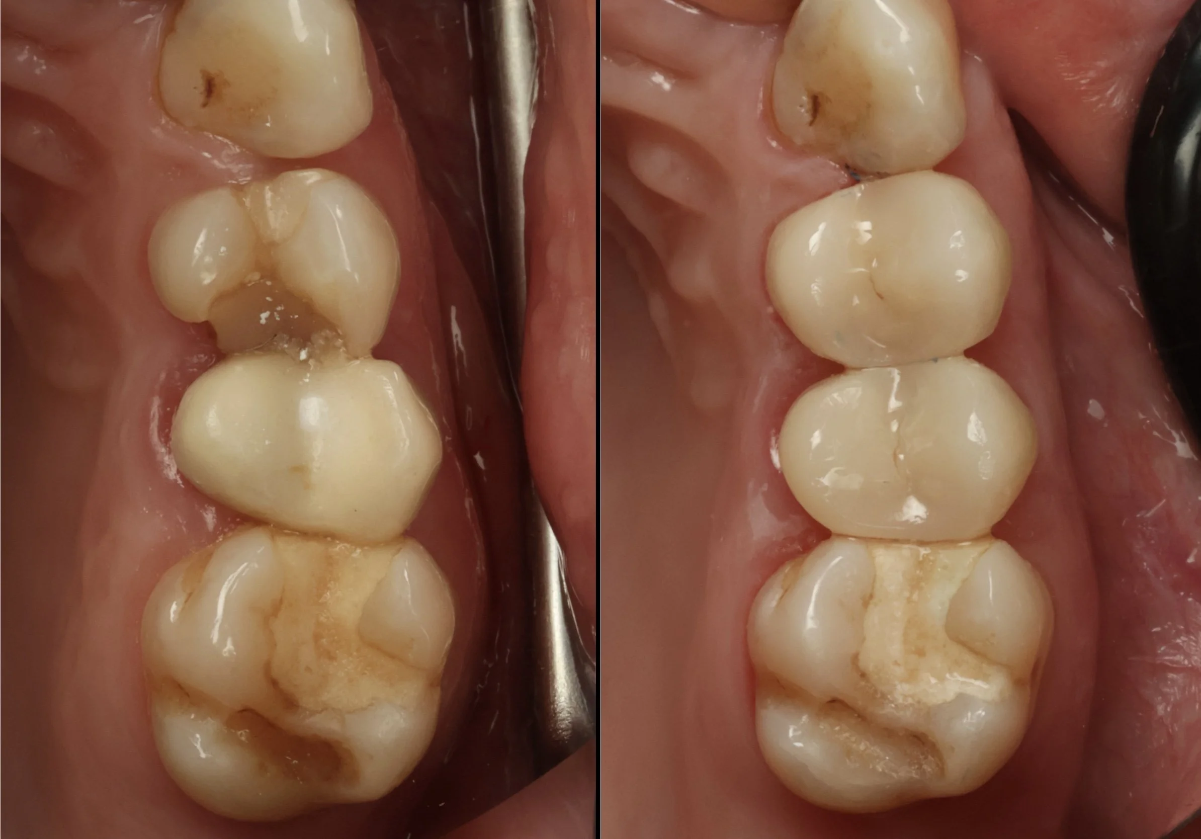Before and after comparison of premolar teeth showing replacement of worn vulnerable teeth with new dental crowns