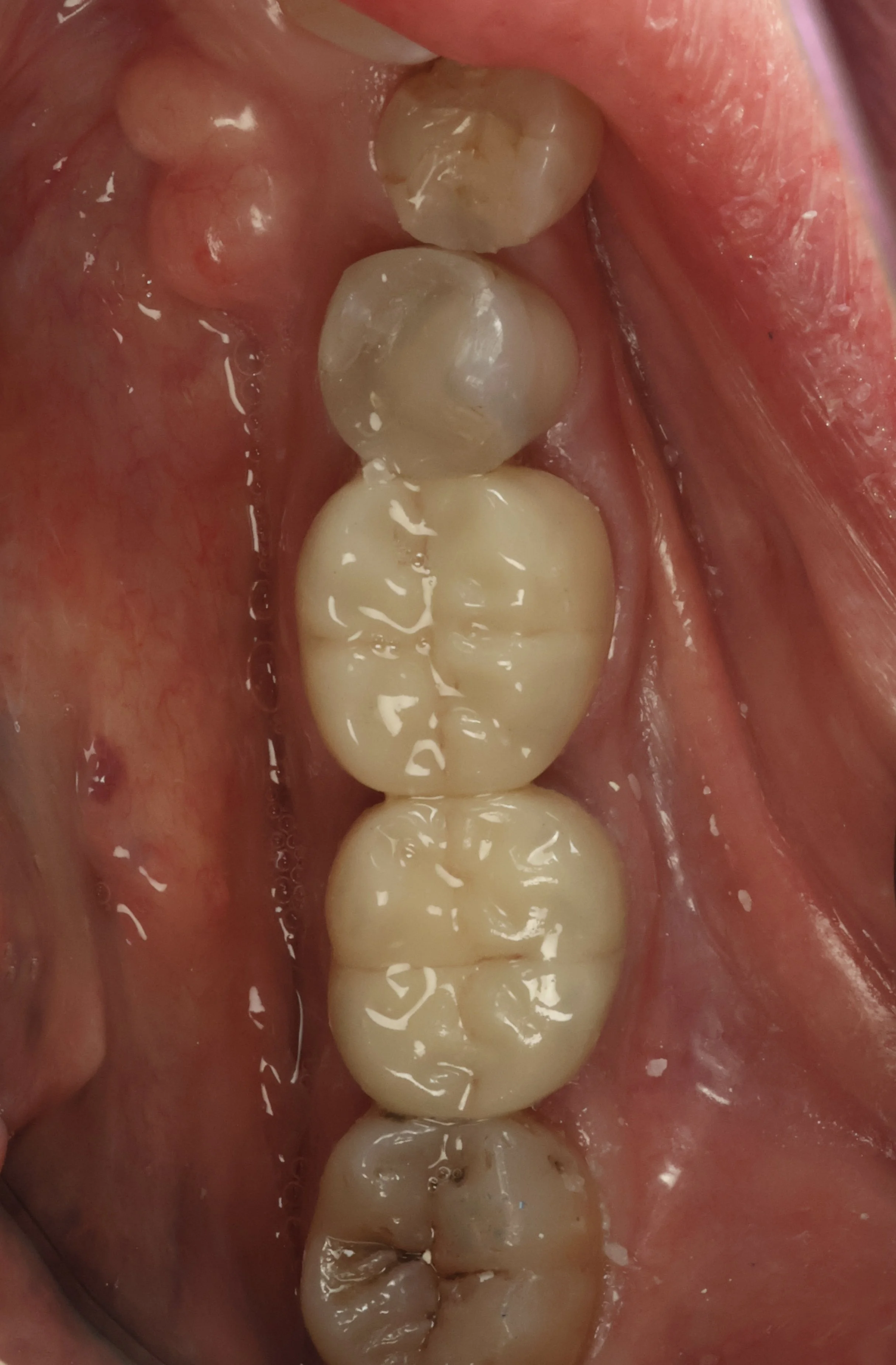 Upper molars and premolars inside a mouth, showing teeth with some discoloration and wear.