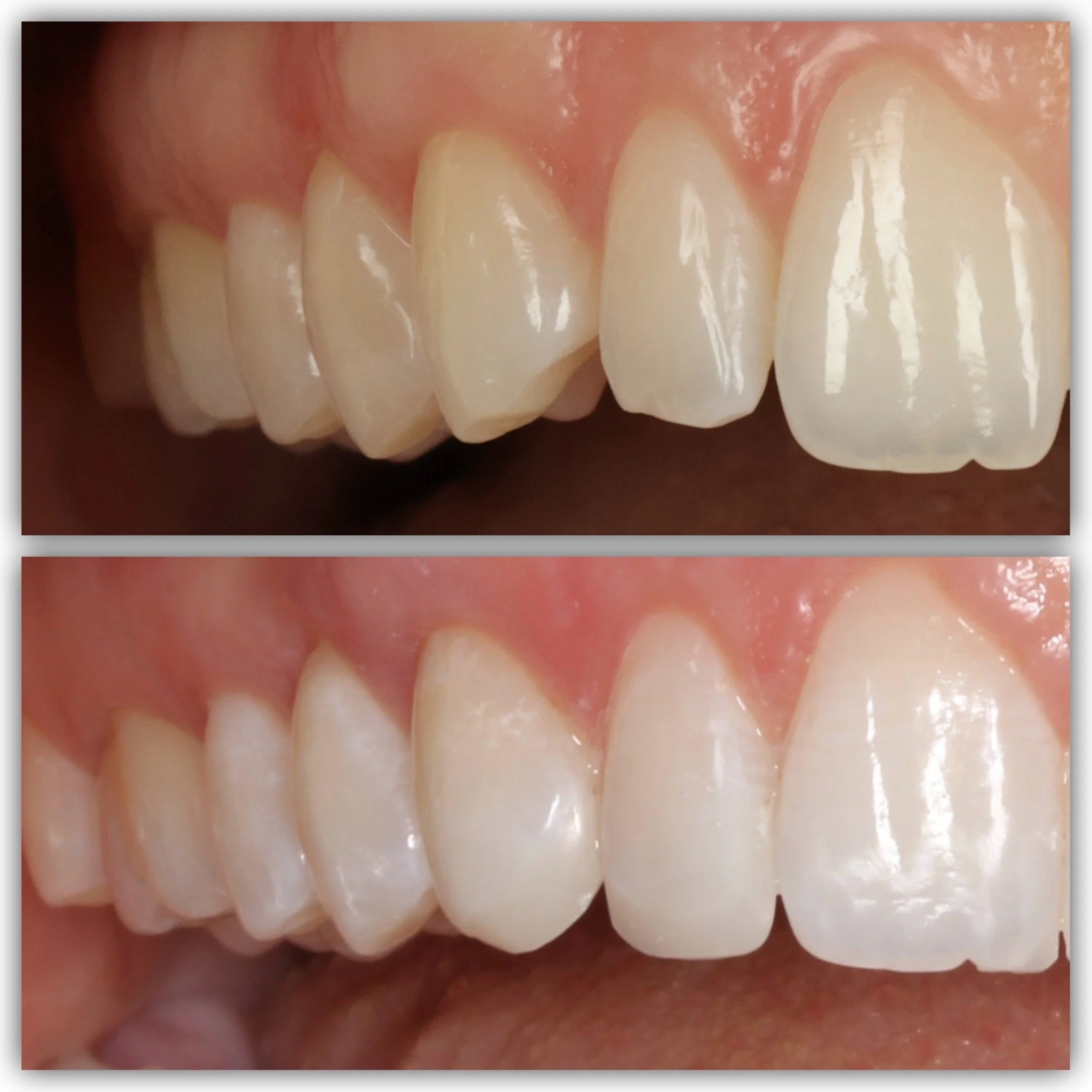Close-up of teeth on a patients right side showing Before and after cosmetic dentistry showing upper front teeth with whitening and improved alignment by a cosmetic dentist in London