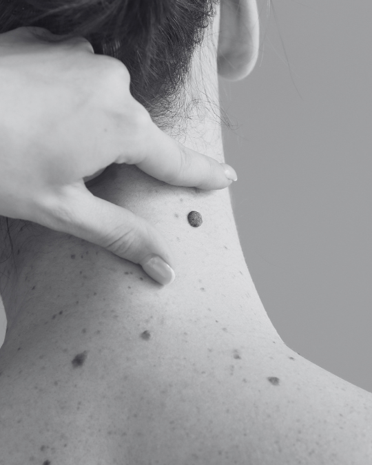 close up of a womans neck and hand highlighting a raised mole to be checked