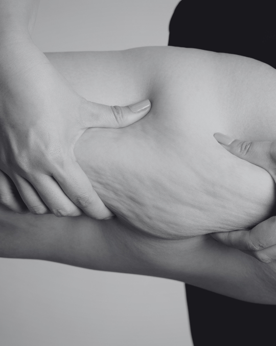 Close up of a woman holding the excess skin on her thigh with two hands