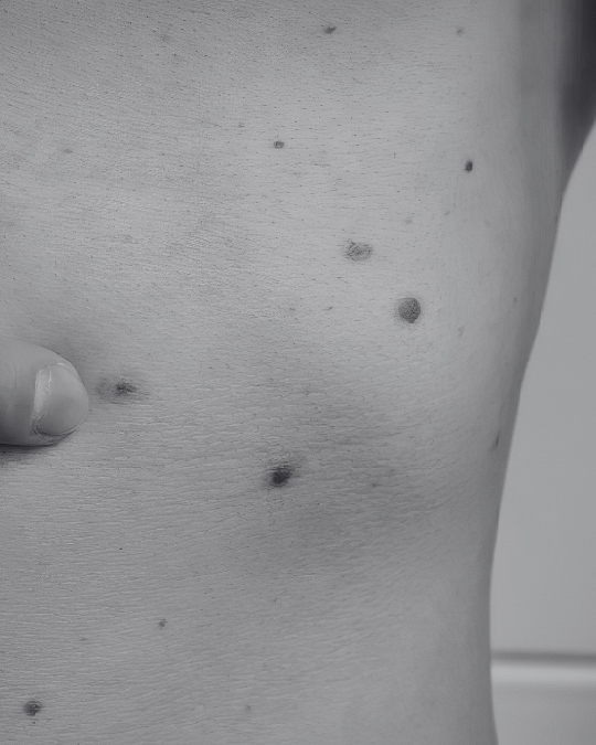 Close up of a mans torso which is covered in moles