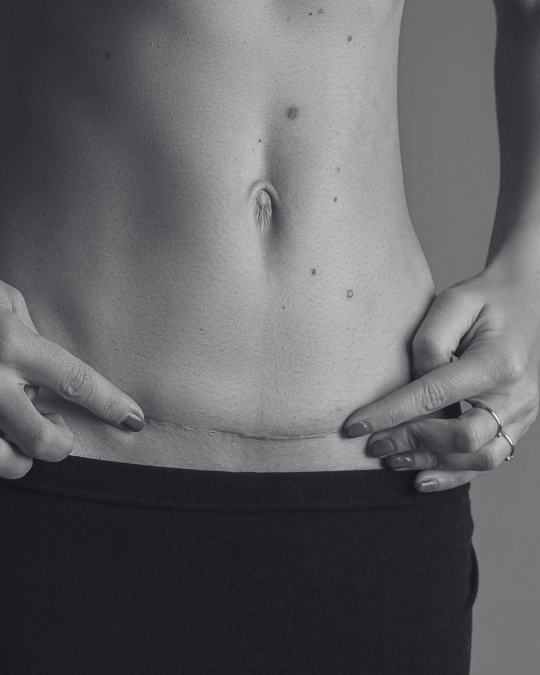 Woman with her stomach out touching both hands to a scar at the bottom of her stomach