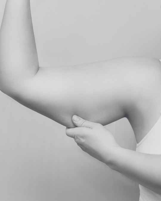 Woman holding her arm up and pinching the excess skin with her other hand
