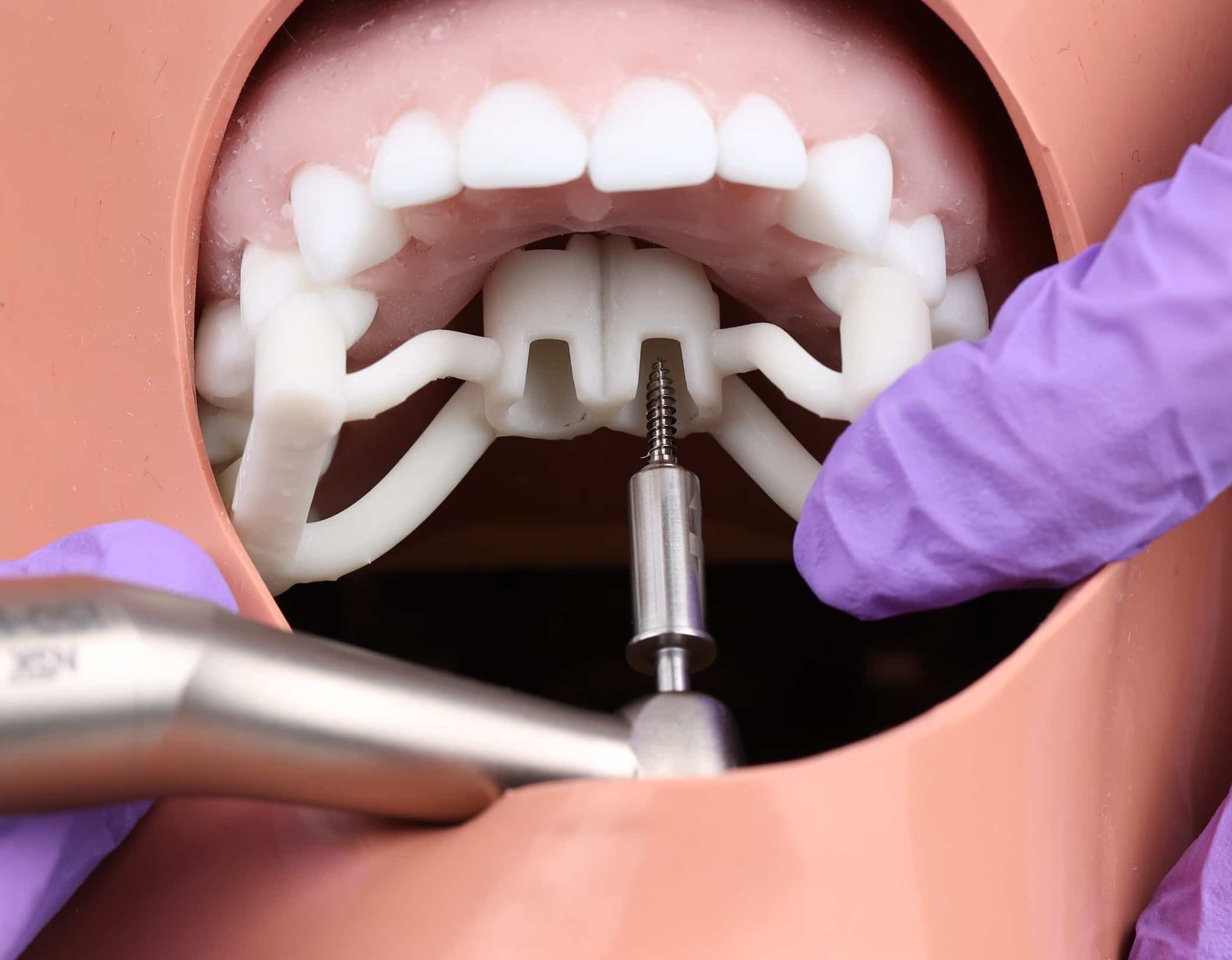 Dental procedure on a model of the human mouth with a dental implant being inserted, using dental tools, and wearing purple gloves.