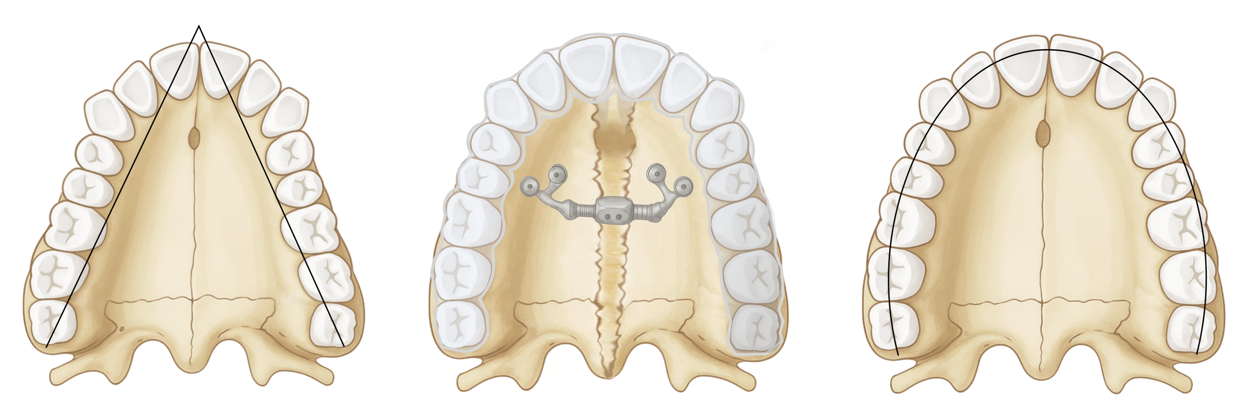 DOMEzero Skeletal Maxillary Expansion without Gap