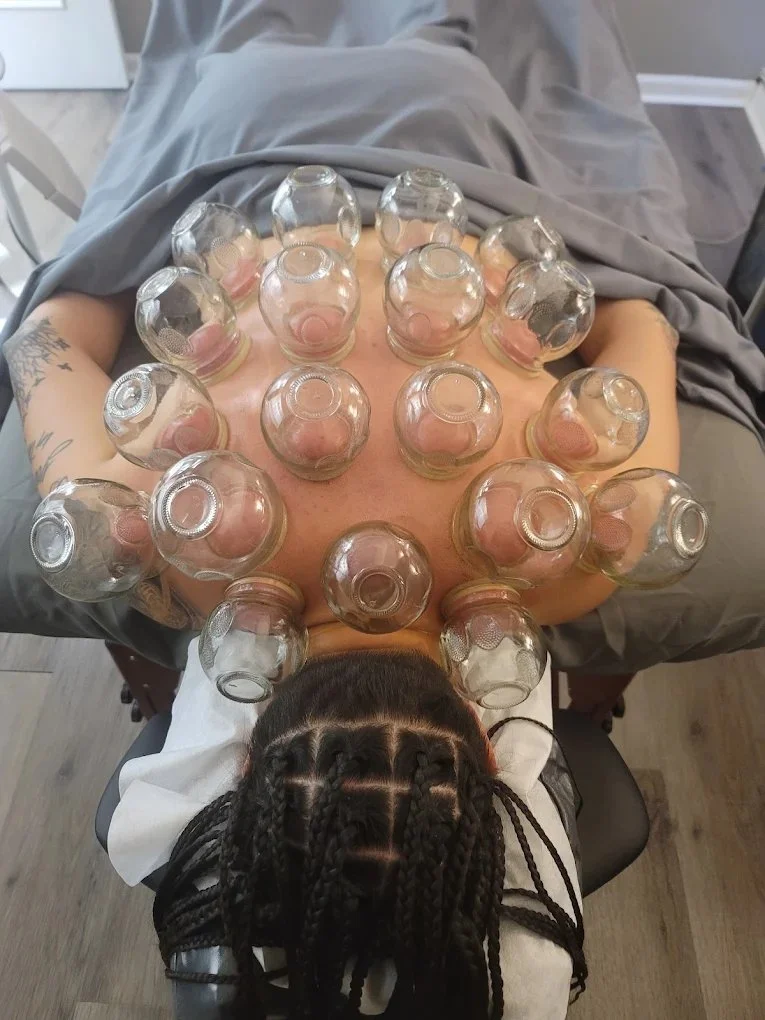 Cupping therapy treatment on a patient’s back