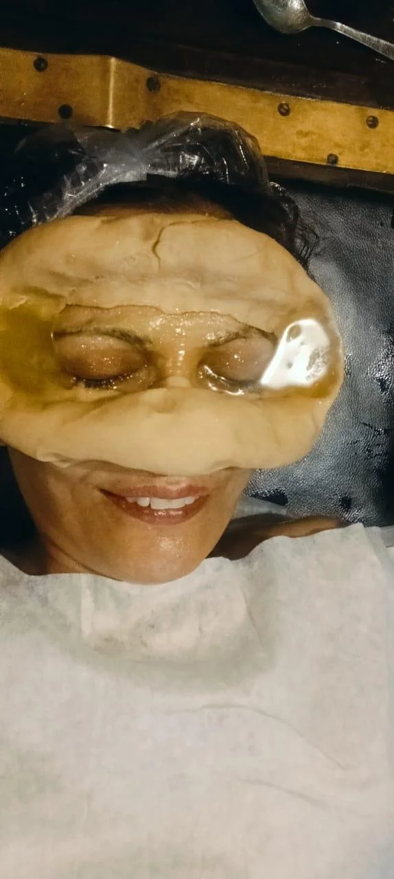 Anu on the massage table with flour dam and warm ghee on her eyes