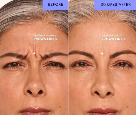 Before-and-after photos of a woman who received botox between her eyebrows on her frown lines