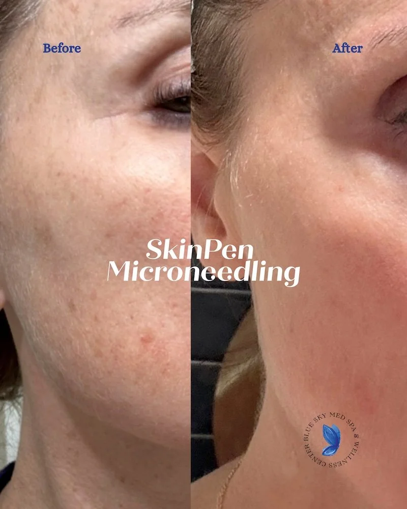 Before-and-after photos of a woman who underwent skin pen microneedling