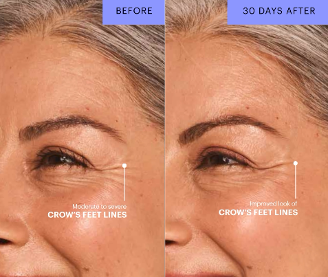 Before-and-after photos of a woman who received botox on her crow's feet lines