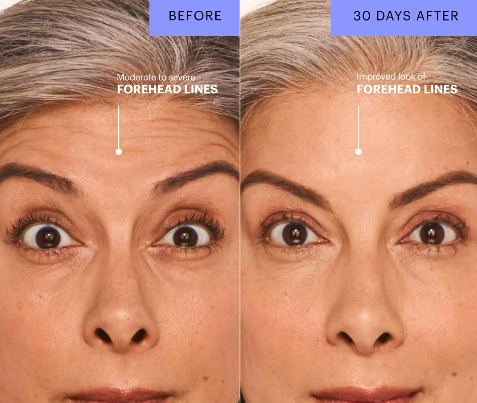 Before-and-after photos of a woman who received botox on her forehead lines