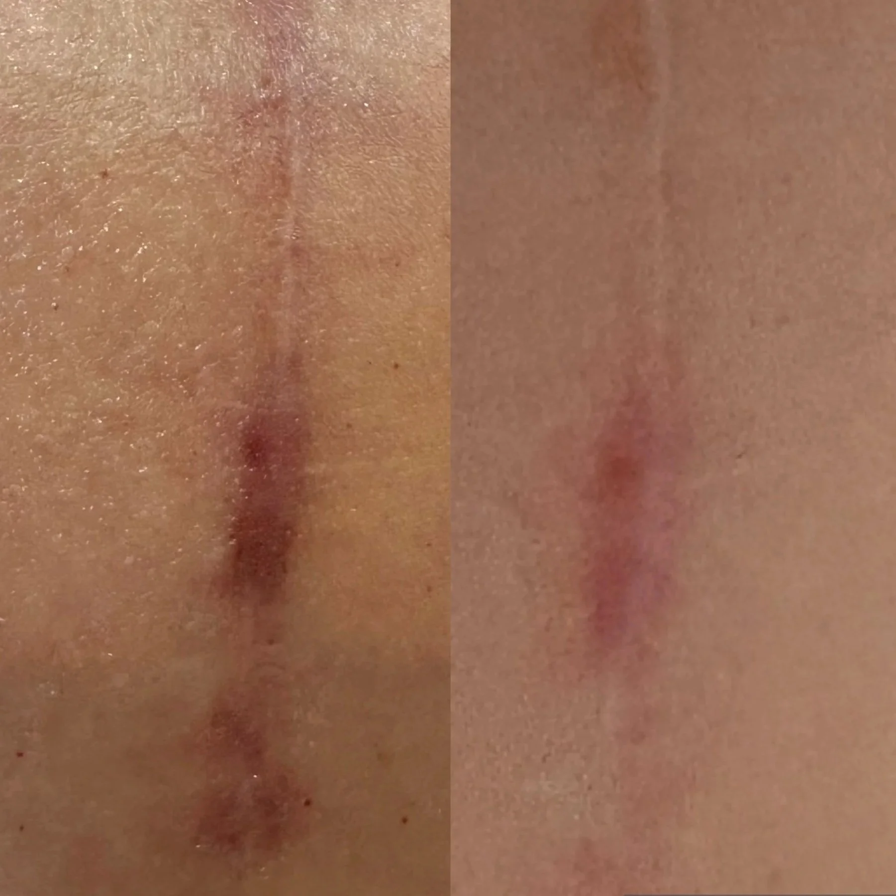 Before-and-after photos of a scar that used GHK-Cu cream