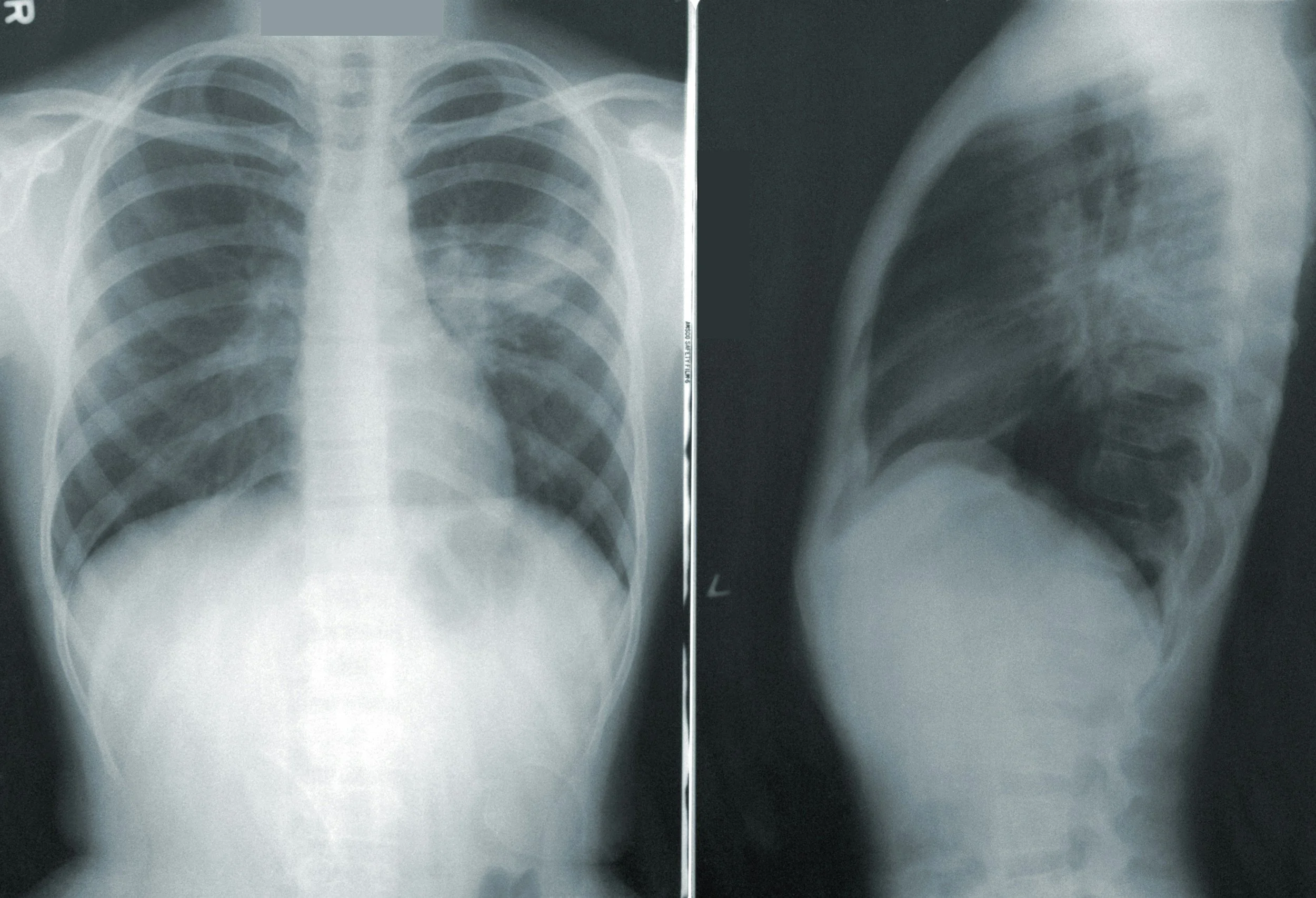Chest X-ray showing the front view on the left and side view on the right of a human chest.